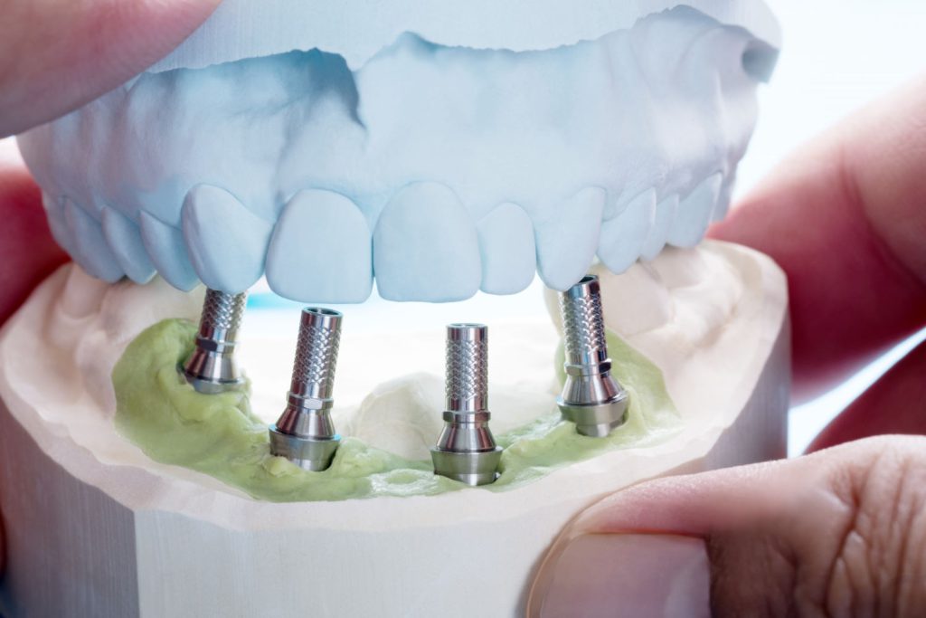 Protezy zębowe są niezastąpionym rozwiązaniem dla osób borykających się z utratą zębów